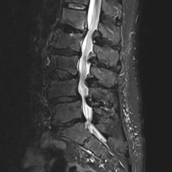 Spinalkanalstenose